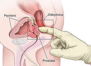 dht and prostate cancer ki gyógyította az xp prostatitiset